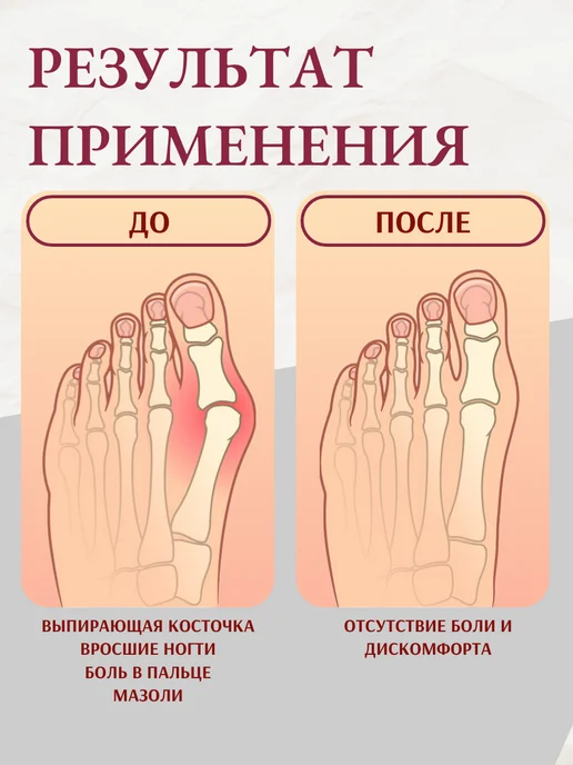 Ortho Walky Разделитель силиконовый для большого пальца, 2 шт, 2 шт, фото 4