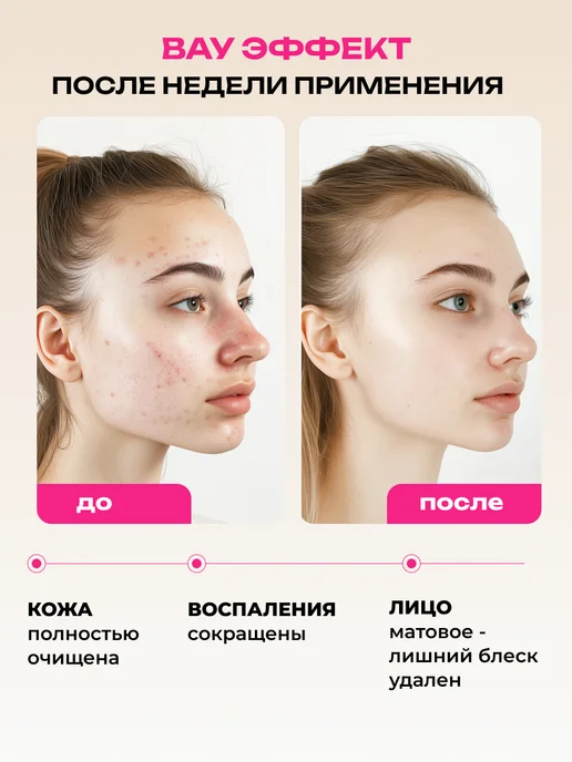 AYA Гель для умывания от прыщей, 250 мл, фото 2