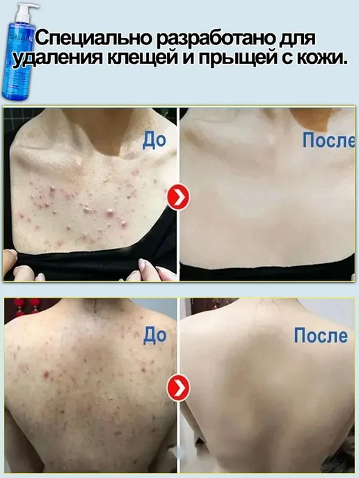 IUALLURE Кислотный Гель для душа от прыщей для тела на спине, вариант, фото 4