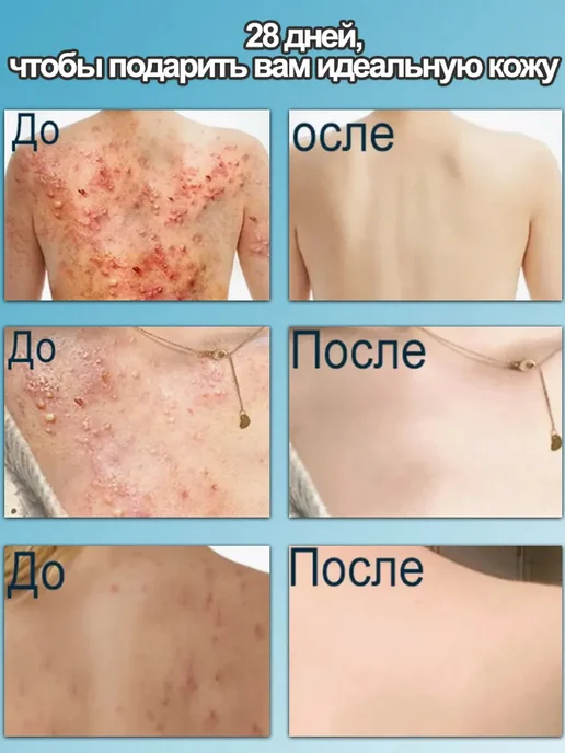 IUALLURE Кислотный Гель для душа от прыщей для тела на спине, вариант, фото 7